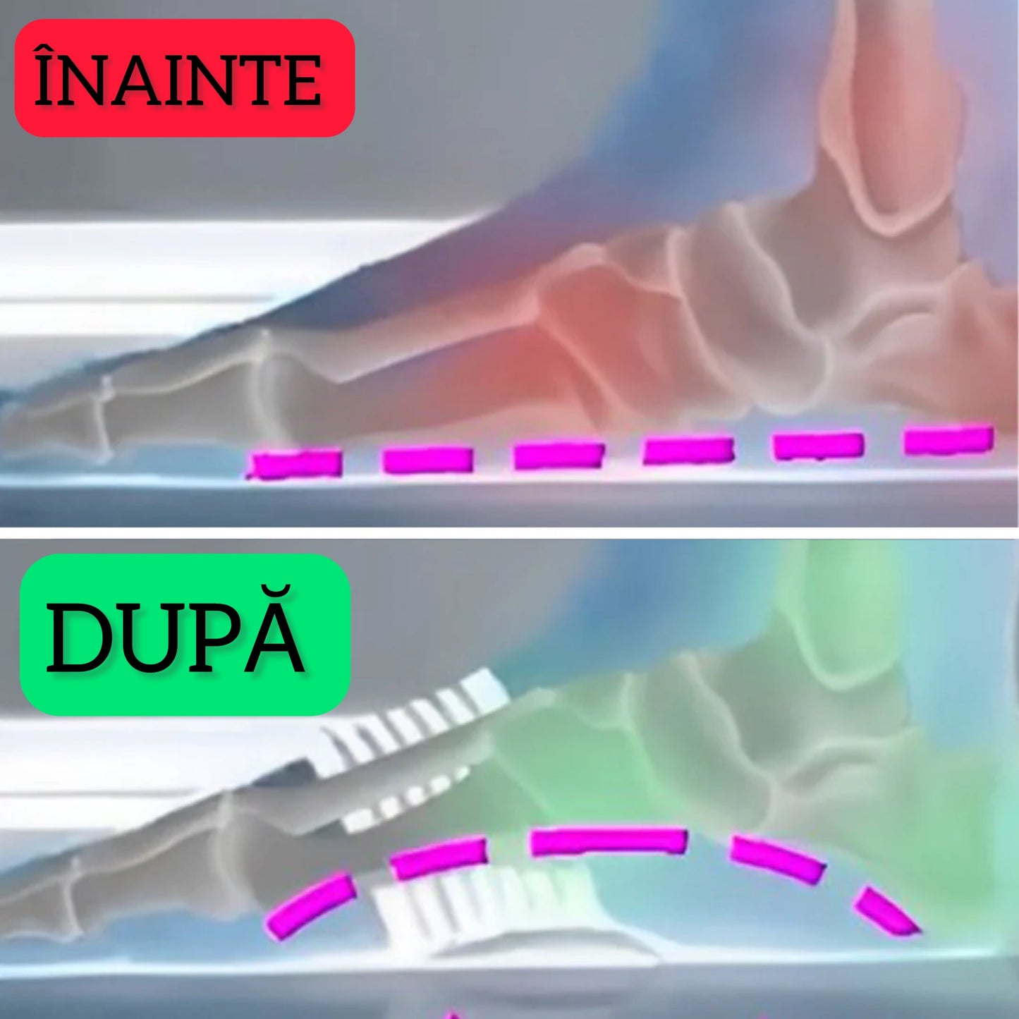 Suporti fasceită plantară - CalcaiFix™ (SET x 2)